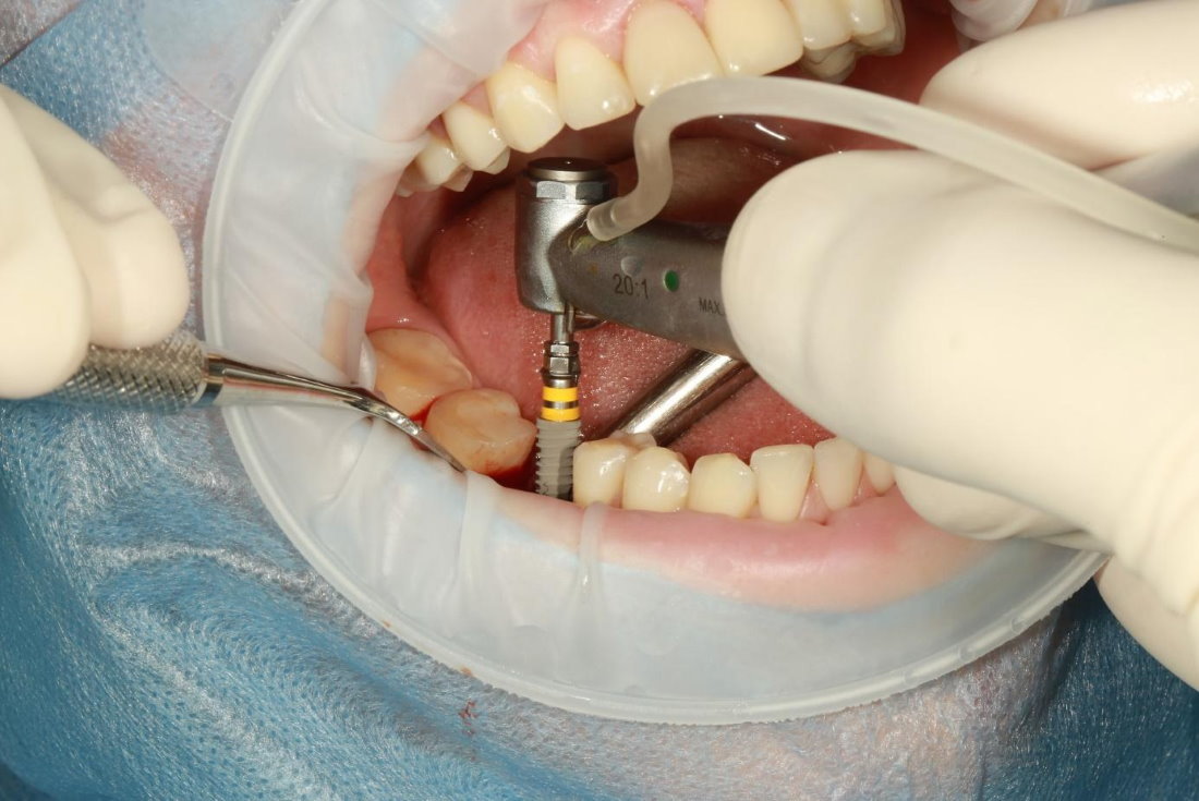 Implanty zębowe - co musisz o nich wiedzieć?